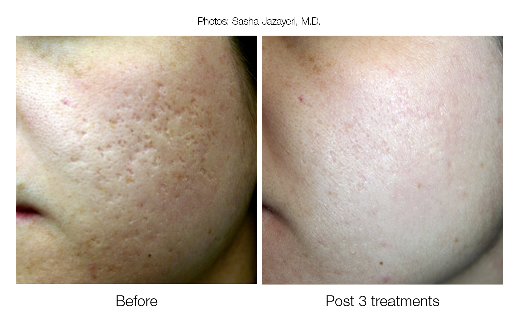 L Acne and acne scar assessment