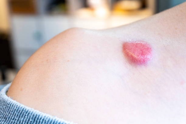 Lumps-and-Bumps-removal Assessment of a raised skin lesion