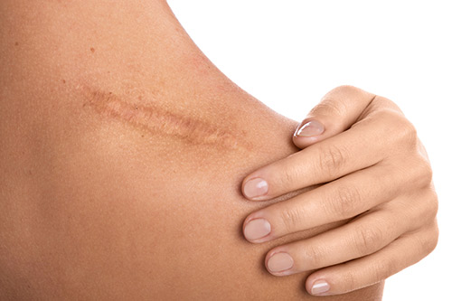 four-scars-in-1701090333 Keloid scar assessment