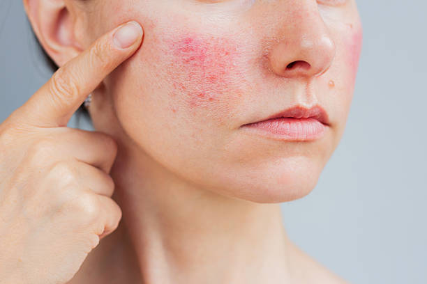 istockphoto-2220867677-612x612 Assessment of facial redness