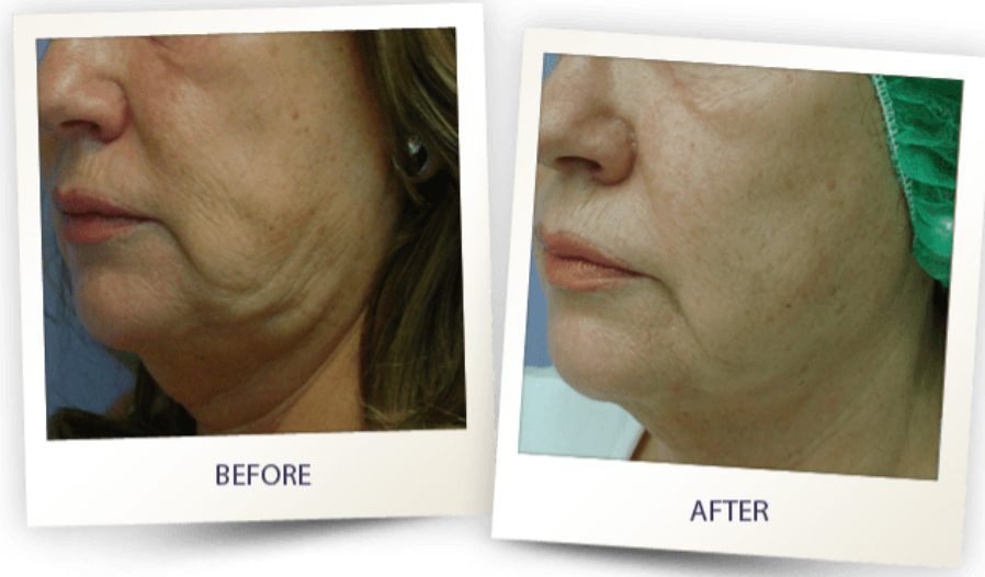 lifting Lifting and tightening treatment