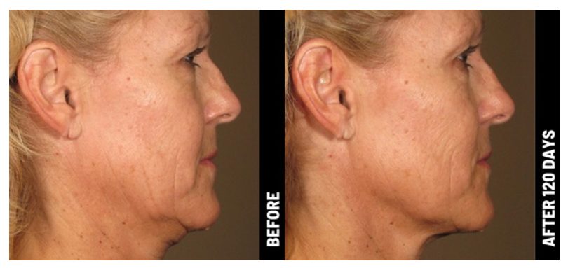liftng Lifting and tightening treatment