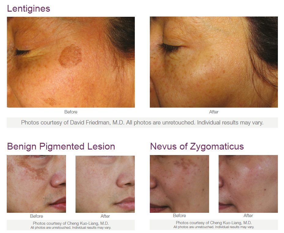 pigment Pigmentation assessment