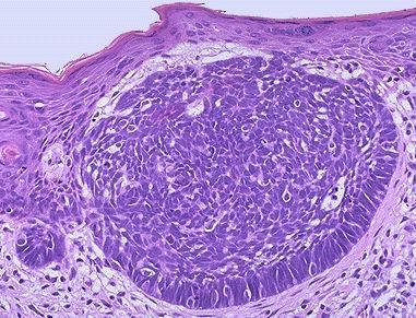 ski Skin cancer examination