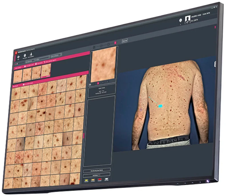 FotoFinder Mole Mapping Skin examination and mole mapping
